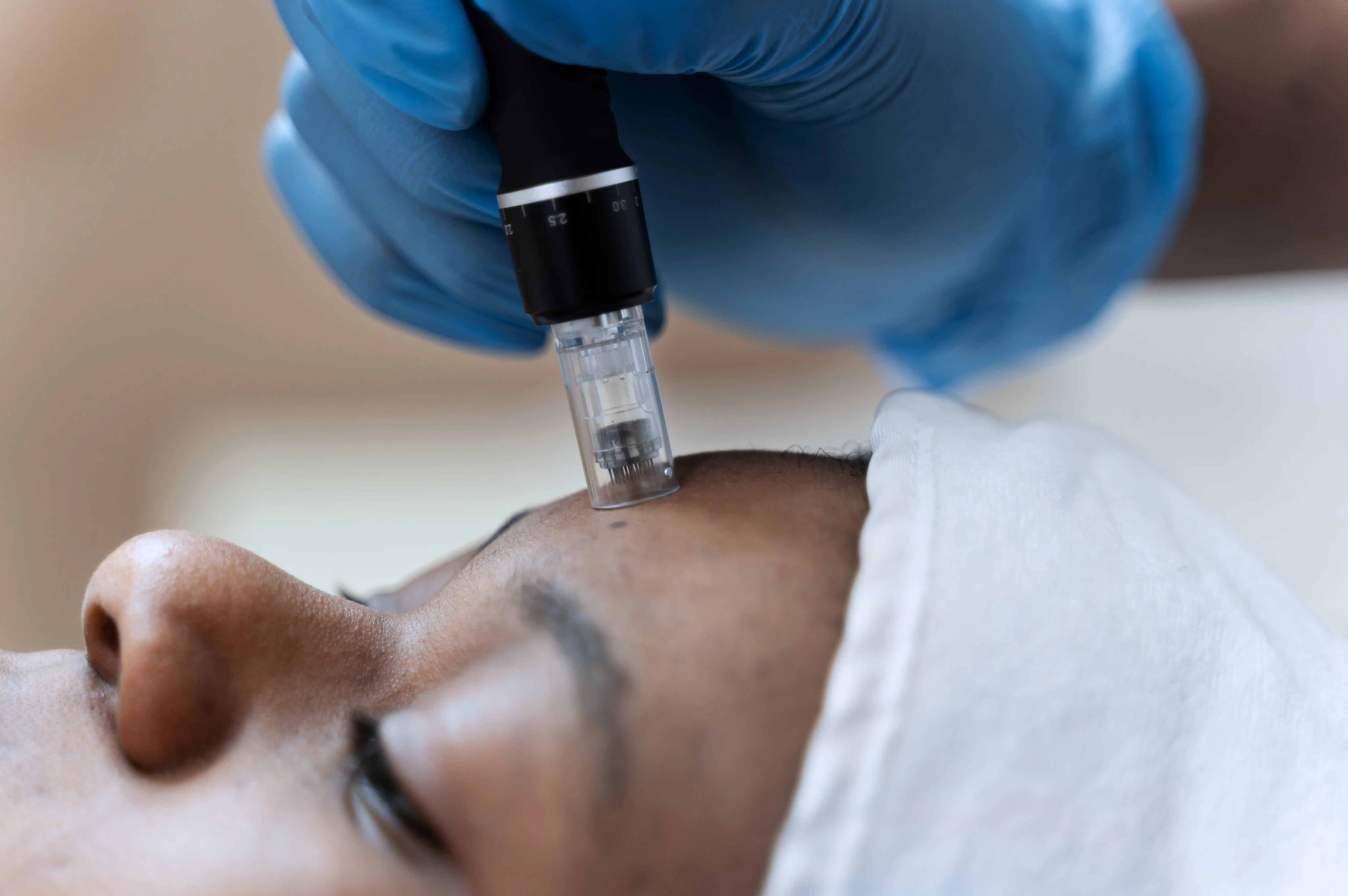Microneedling for black skin