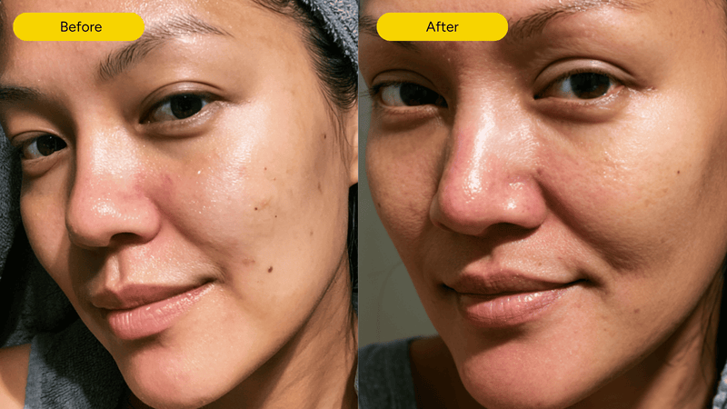 Before and after results with the best exosome skin care products