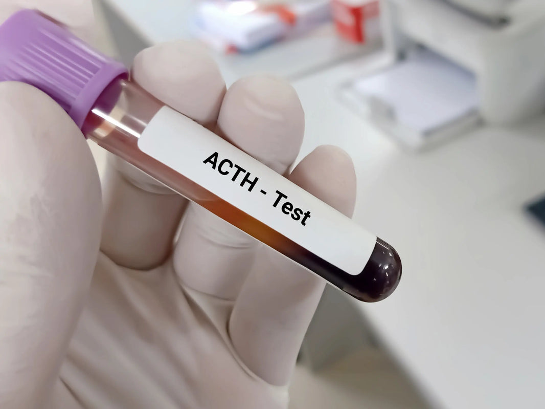 Addison's Disease Hyperpigmentation