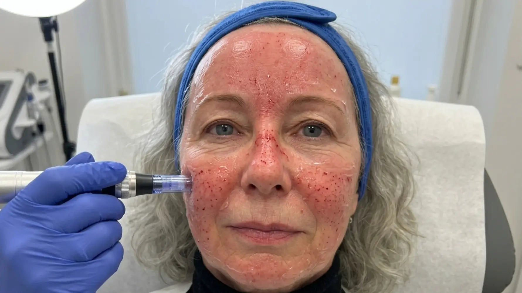 Aftercare After Microneedling