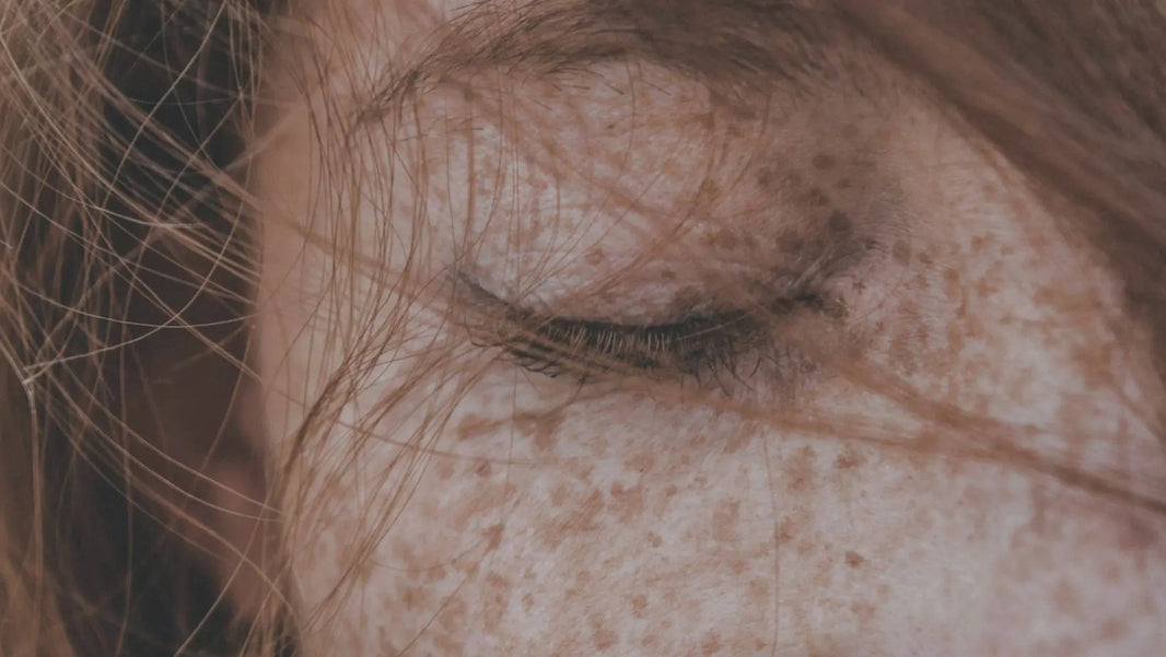 Are freckles hyperpigmentation?