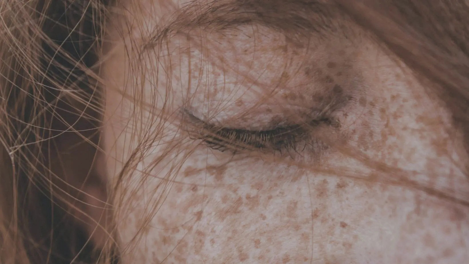 Are freckles hyperpigmentation?
