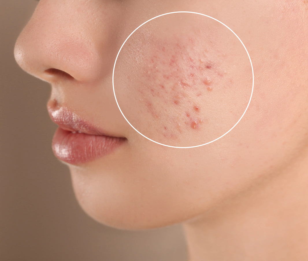 Can Microneedling Cause Acne?