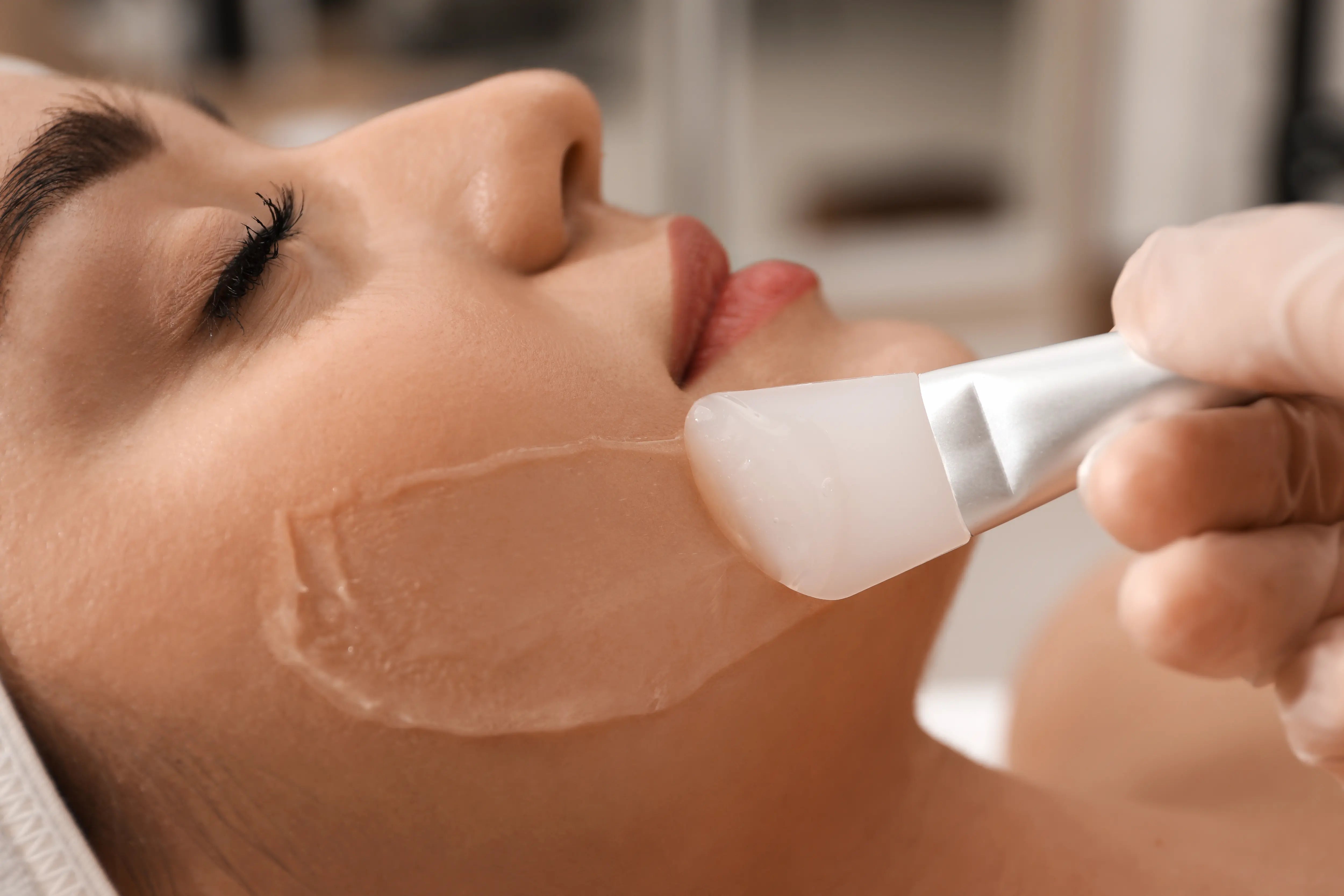 Chemical Peel for Hyperpigmentation