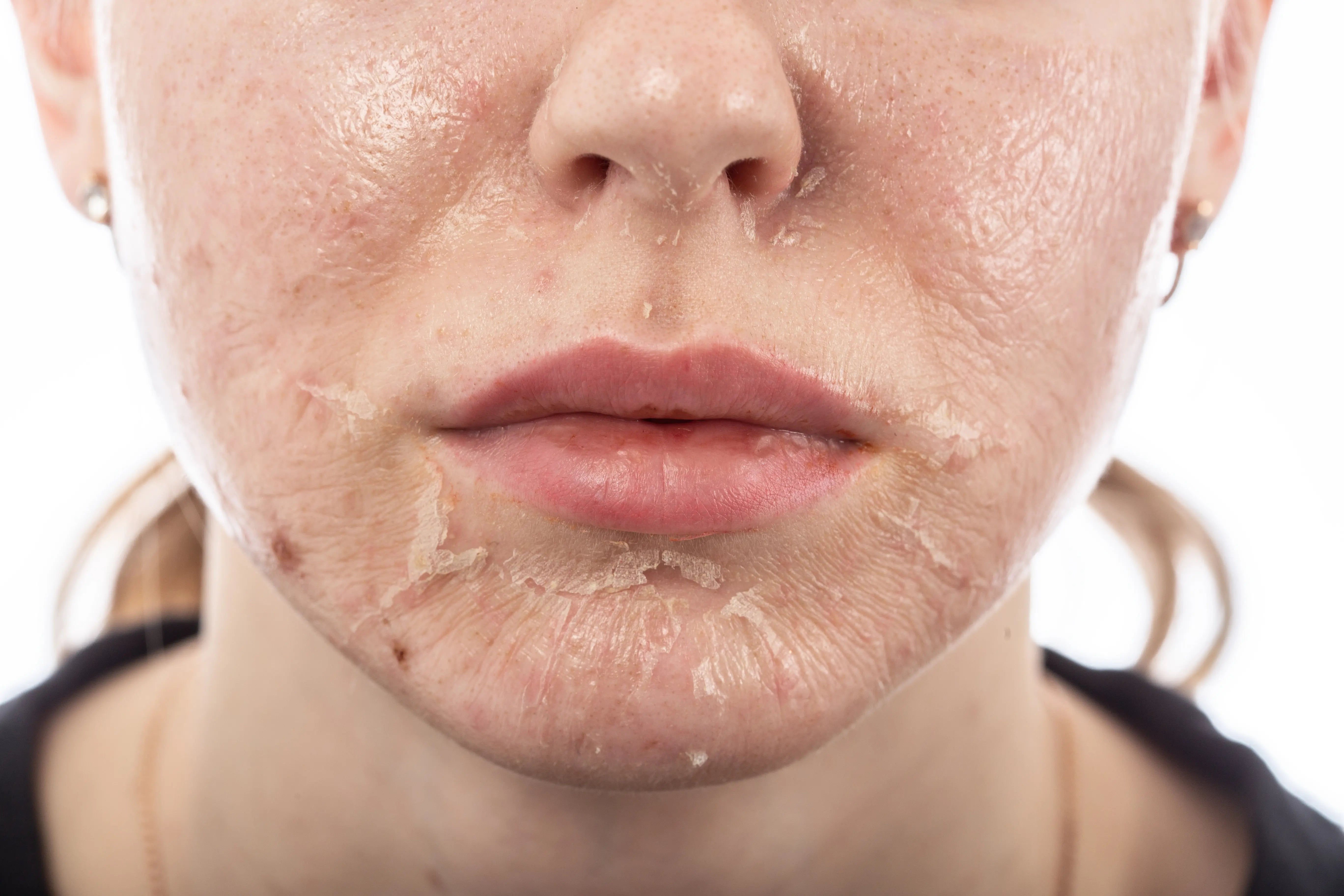 Chemical Peel Benefits