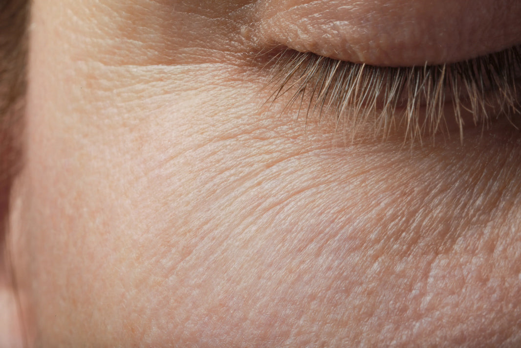 Do Chemical Peels Help With Wrinkles?