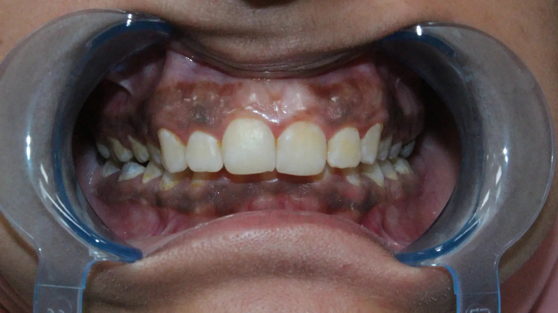 Gum Hyperpigmentation