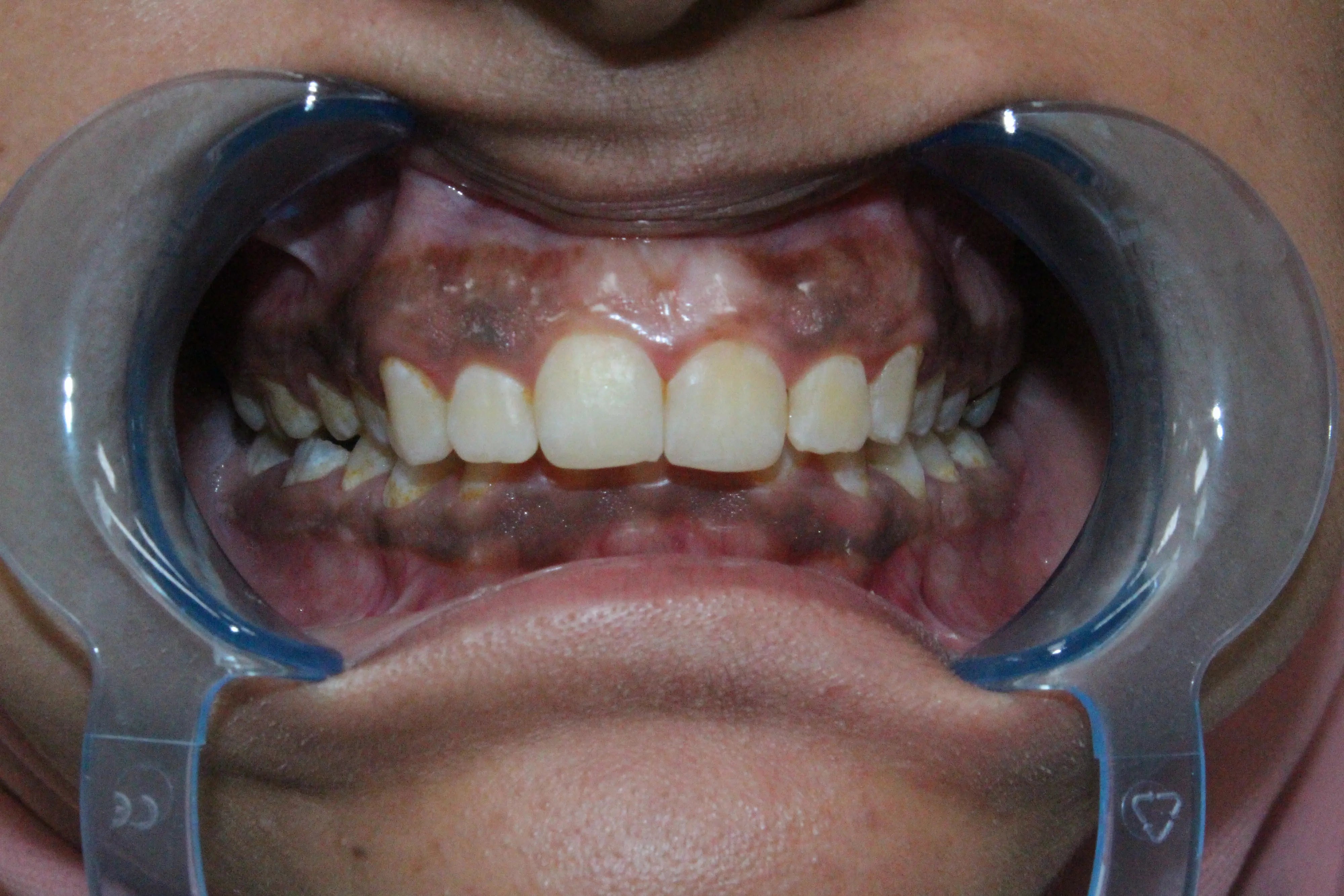 Gum hyperpigmentation