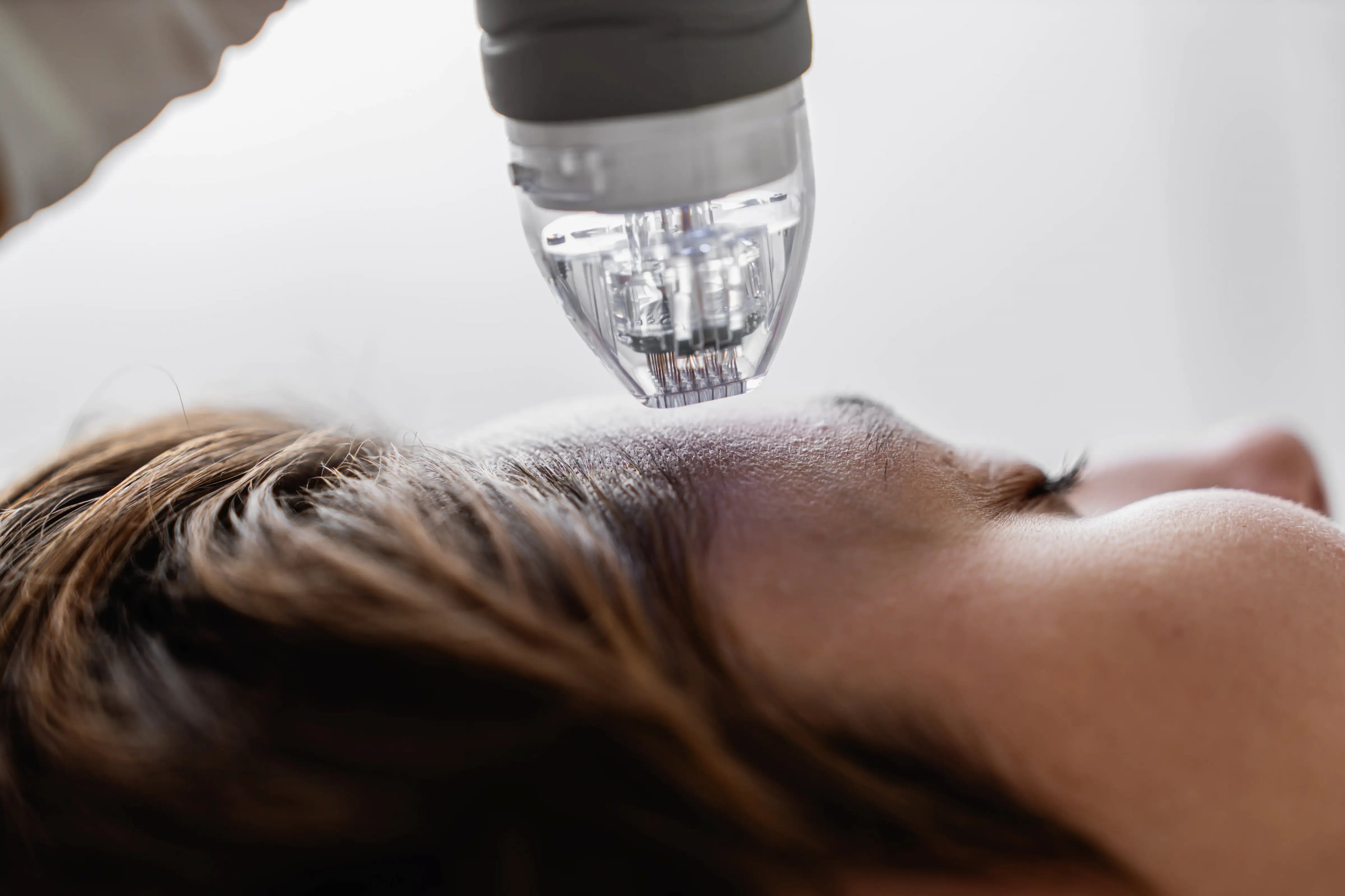 How Long Does Microneedling Last?
