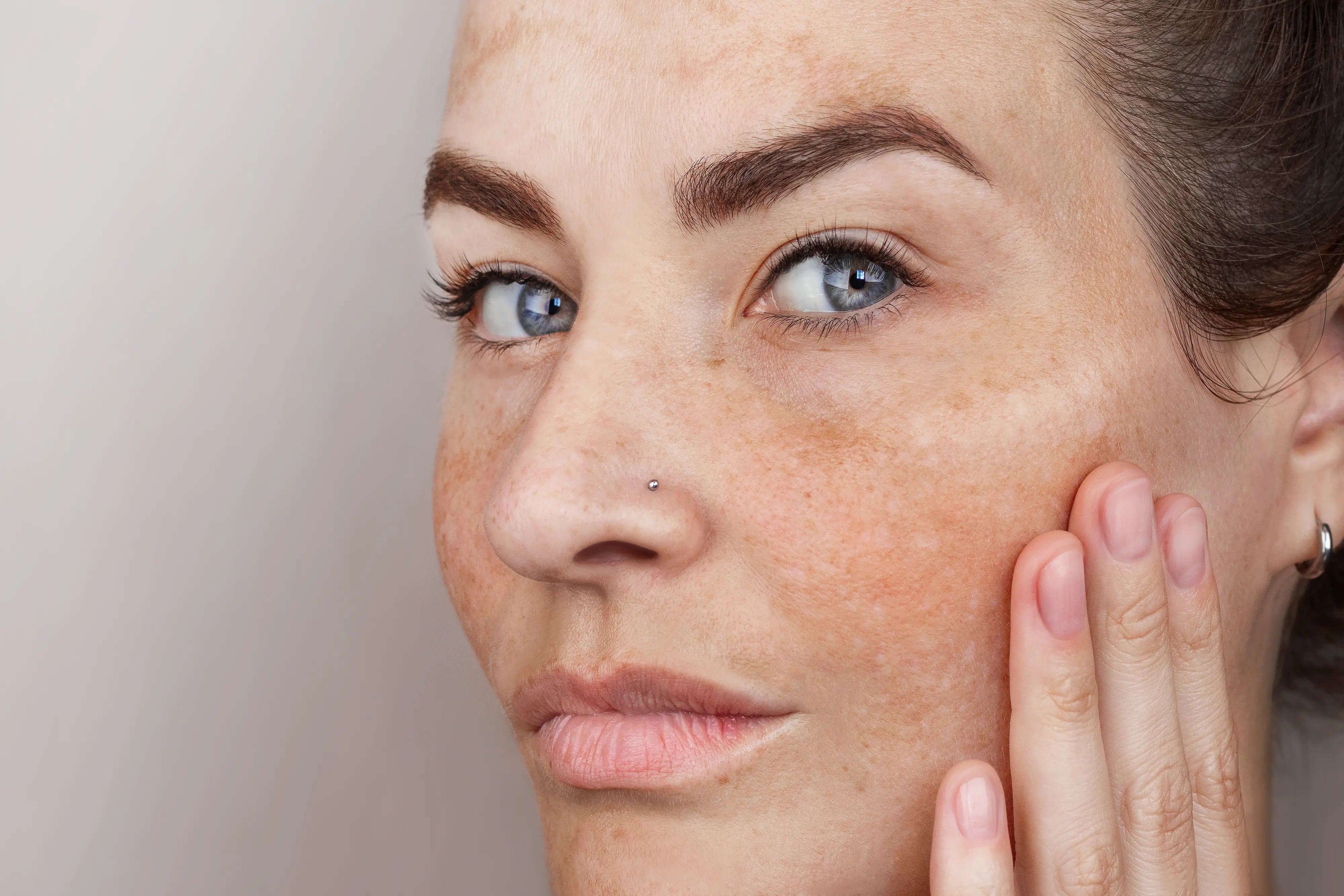 Hyperpigmentation after chemical peel​