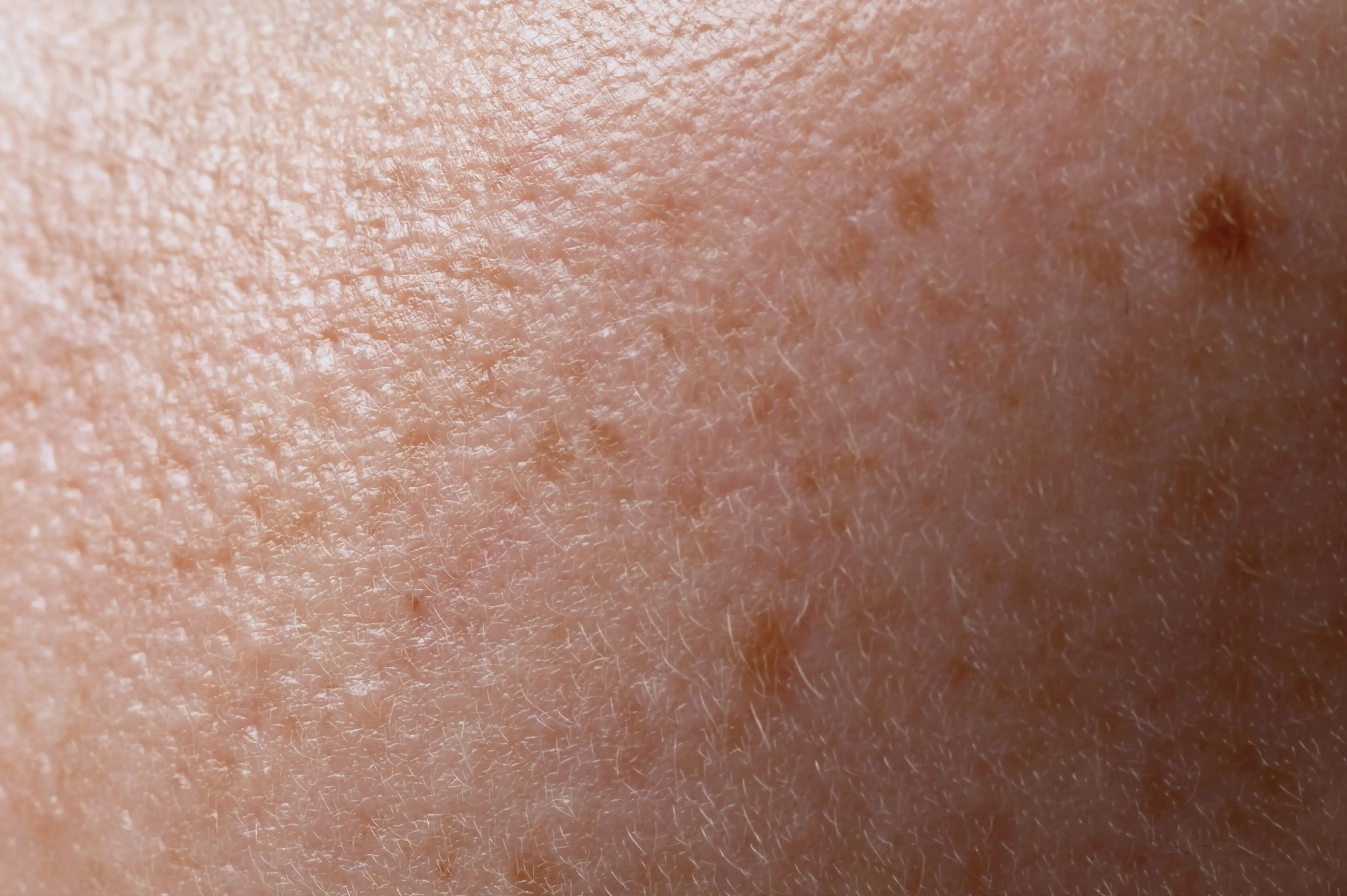 Hyperpigmentation: The Complete Guide