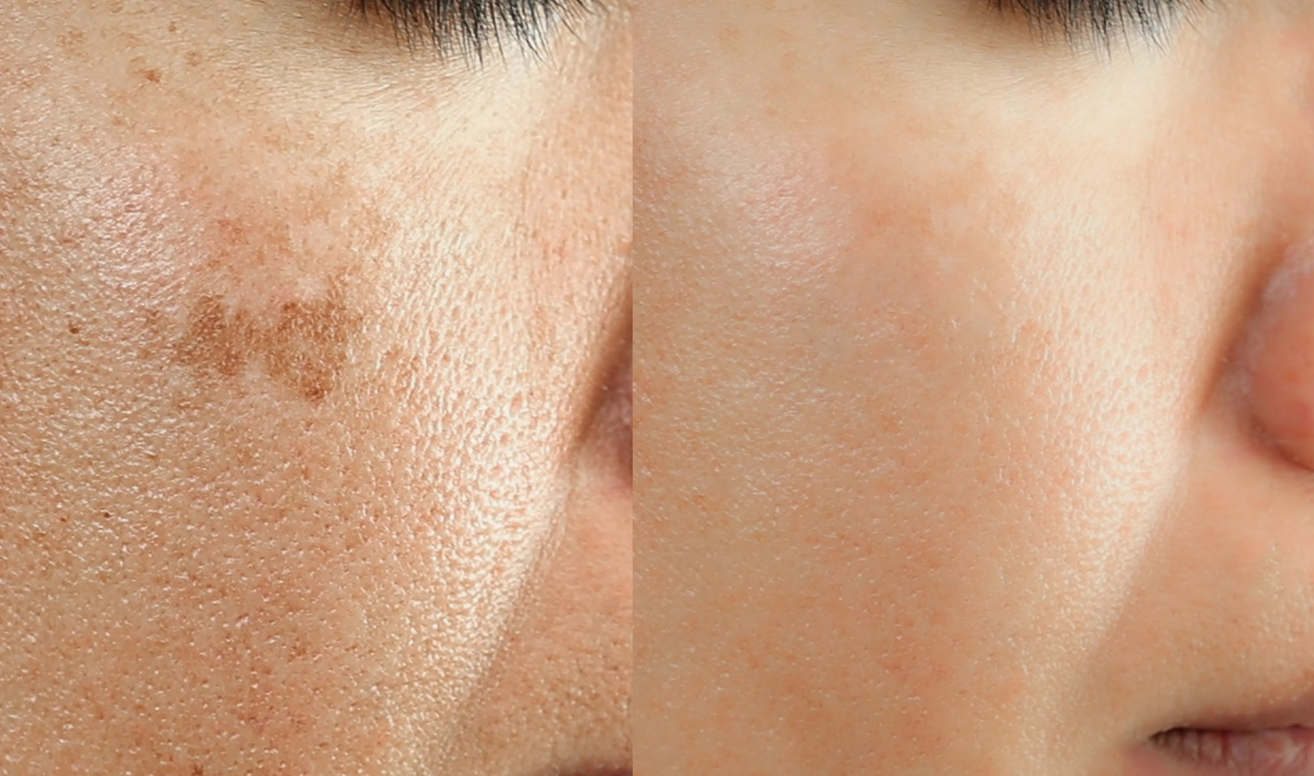 Hyperpigmentation vs Dark Spots - Exosthetics