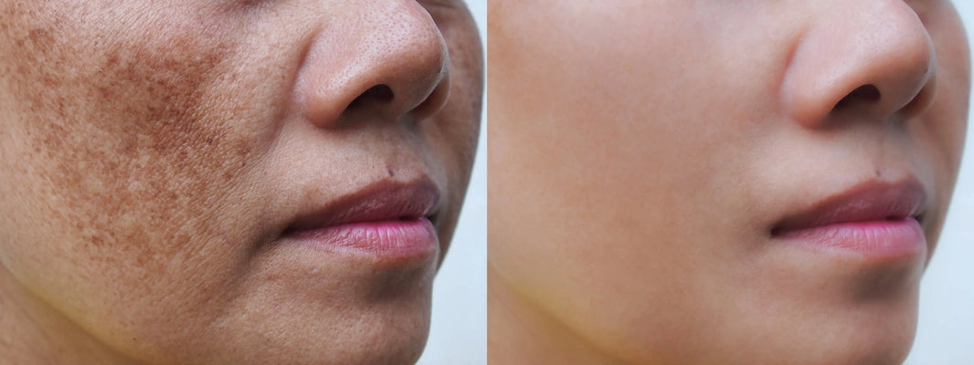 Hyperpigmentation vs Melasma Guide - Myexosthetics