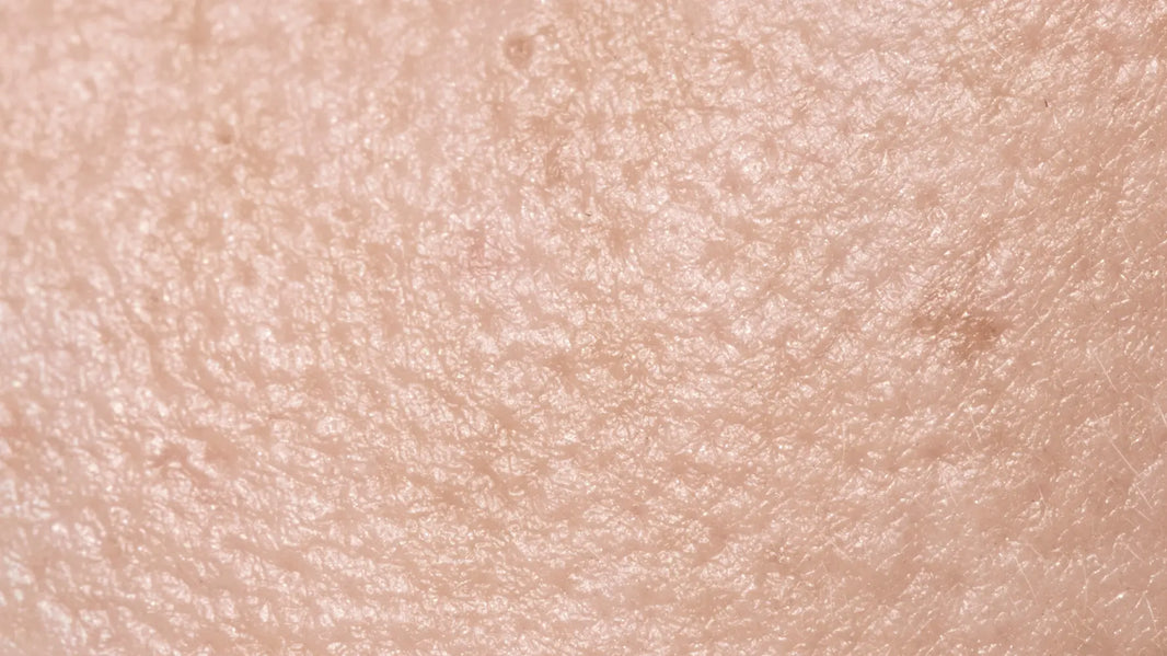 Microneedling For Large Pores