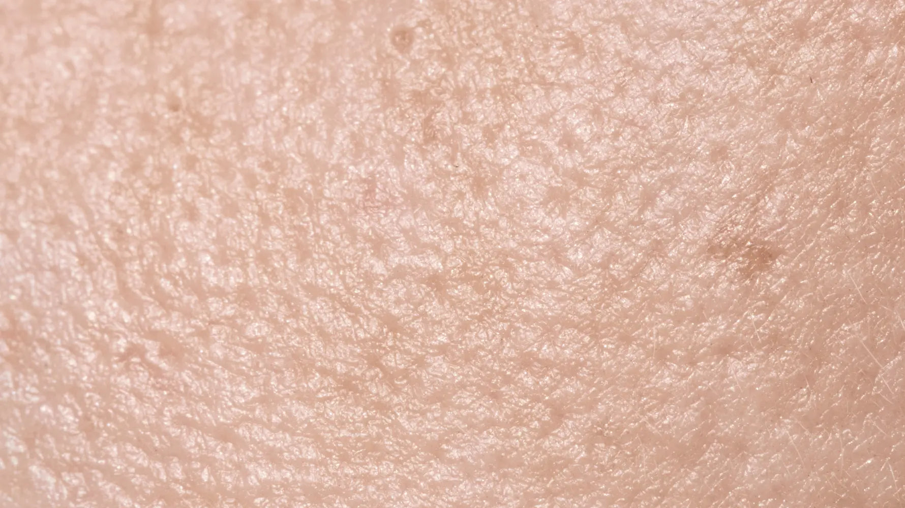 Microneedling For Large Pores