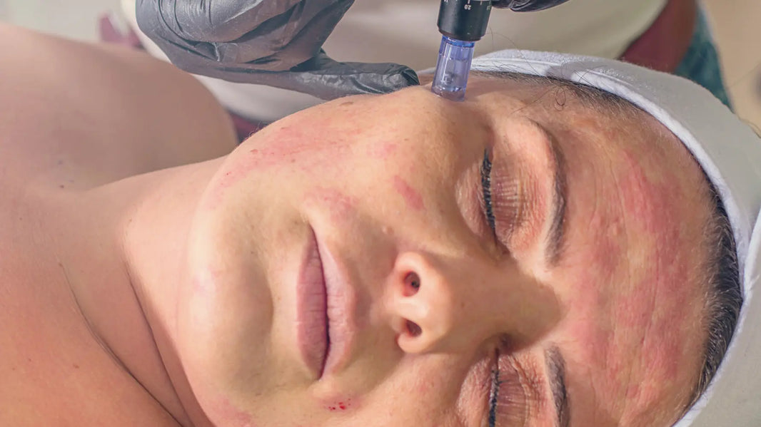 Is Microneedling Worth It?