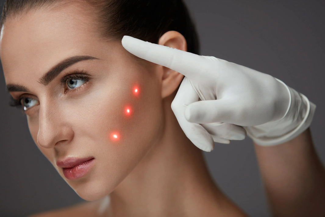 Laser Hyperpigmentation Removal