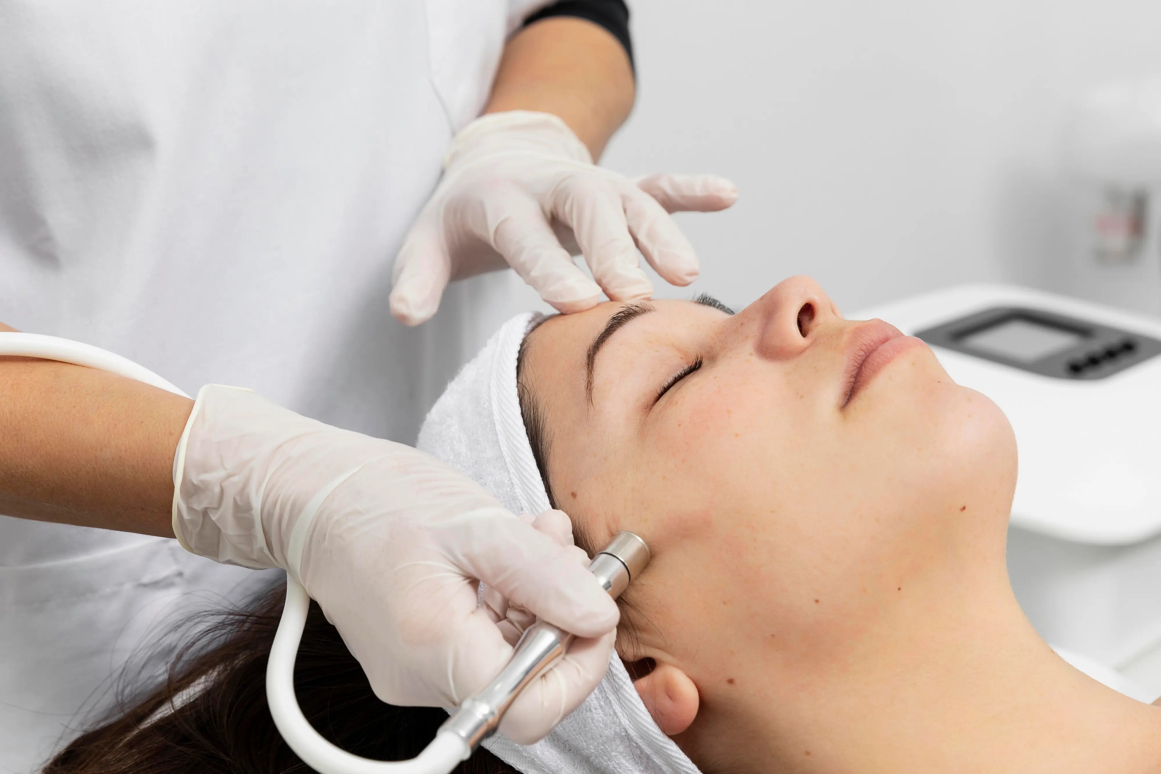 Microdermabrasion for hyperpigmentation