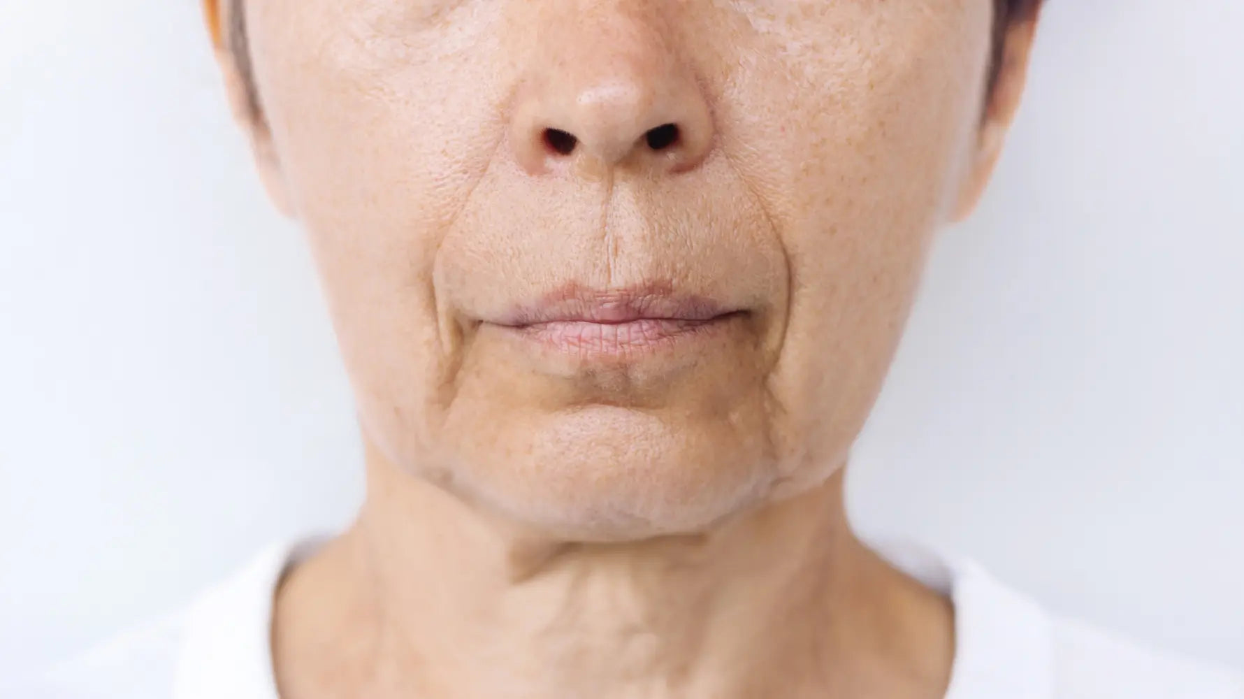 Microneedling For Nasolabial Folds