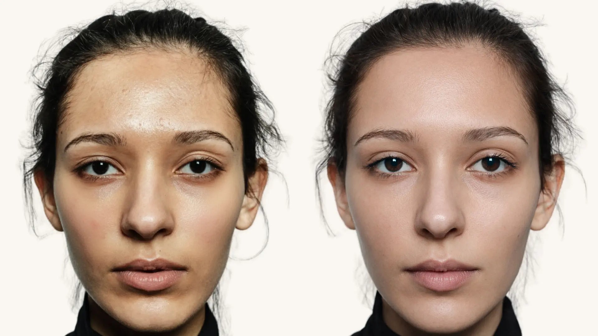 Microneedling Before and After 1 Treatment