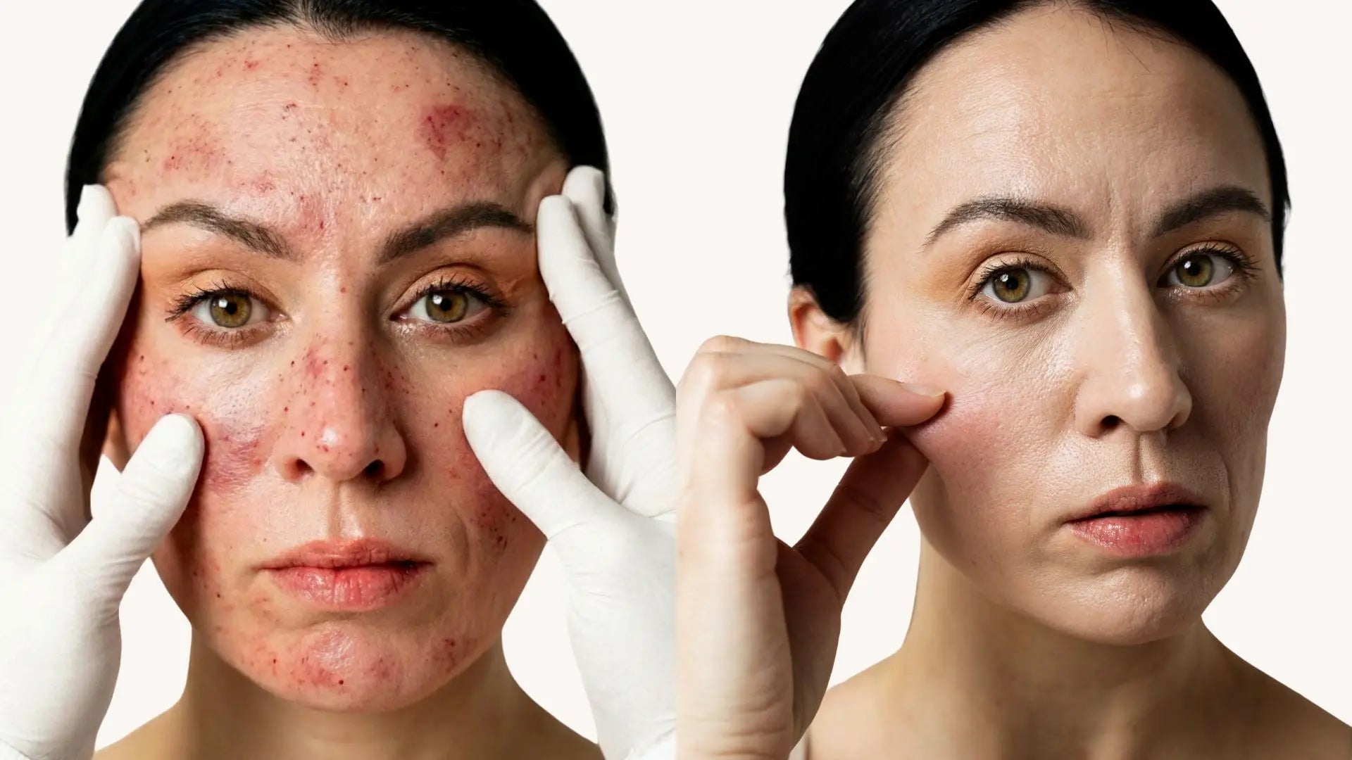 Microneedling Before and After