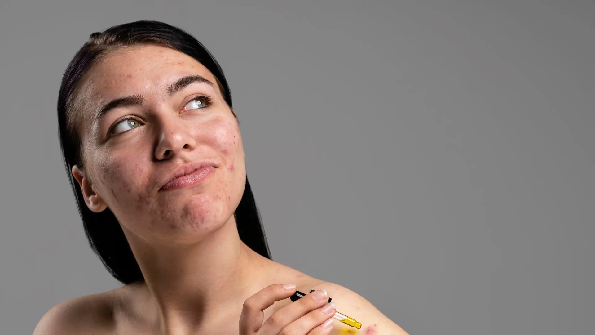 Microneedling Before and After for Acne Scars