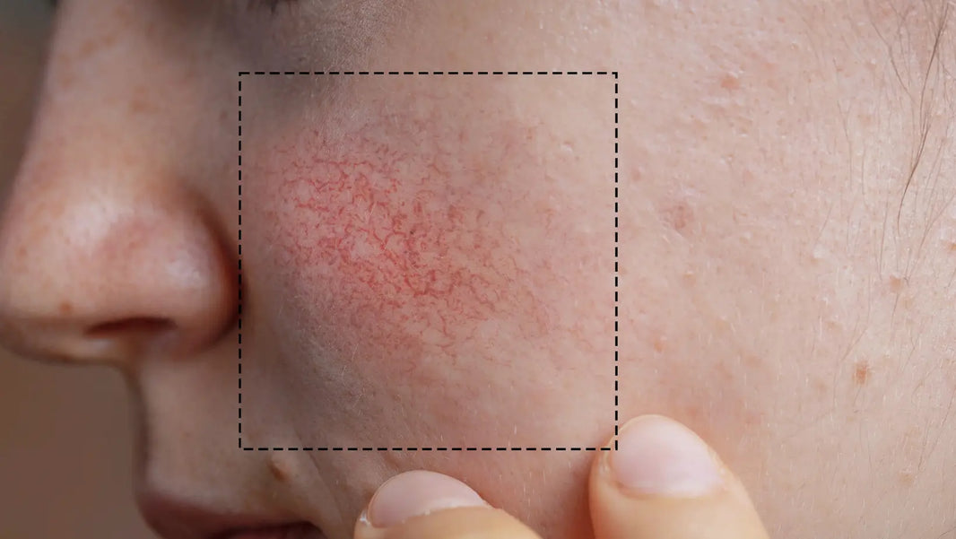 Microneedling and Rosacea