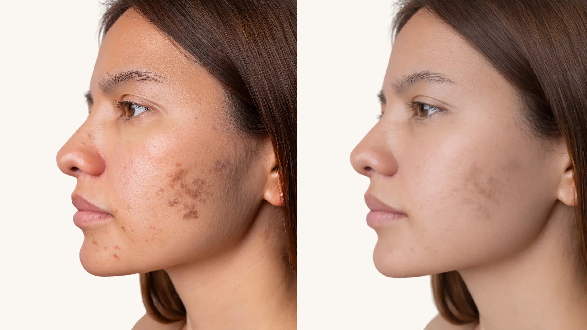 Microneedling before and after for hyperpigmentation