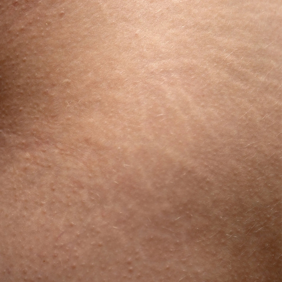 Microneedling Before and After Stretch Marks