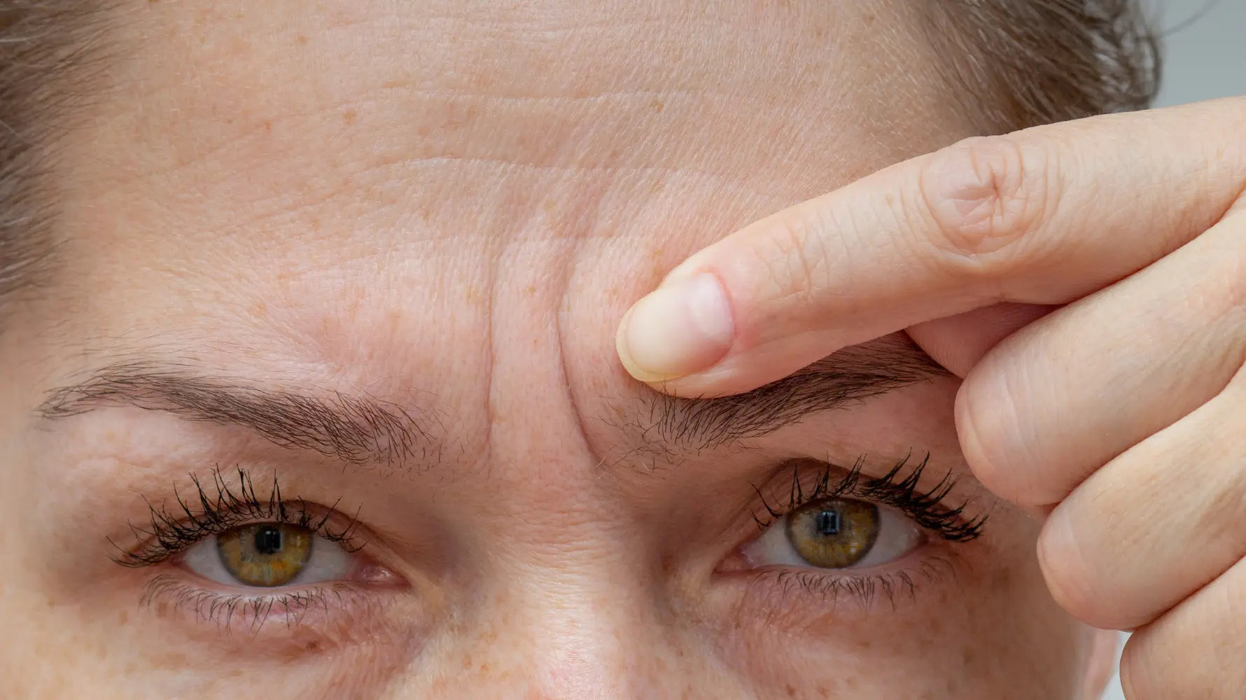 Microneedling for Forehead Wrinkles