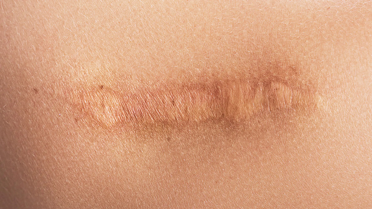 Microneedling for Scars