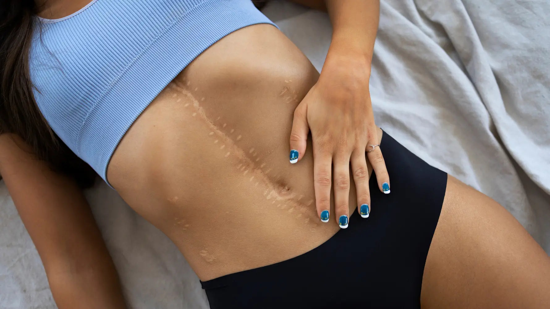 Microneedling for Surgical Scars