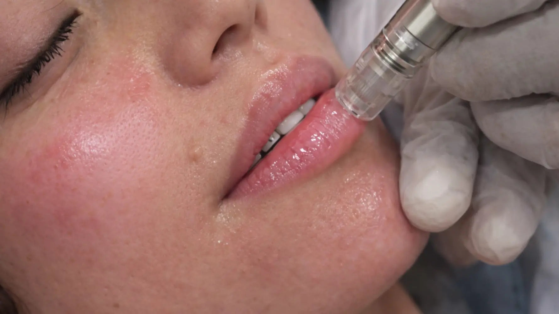 Microneedling lips