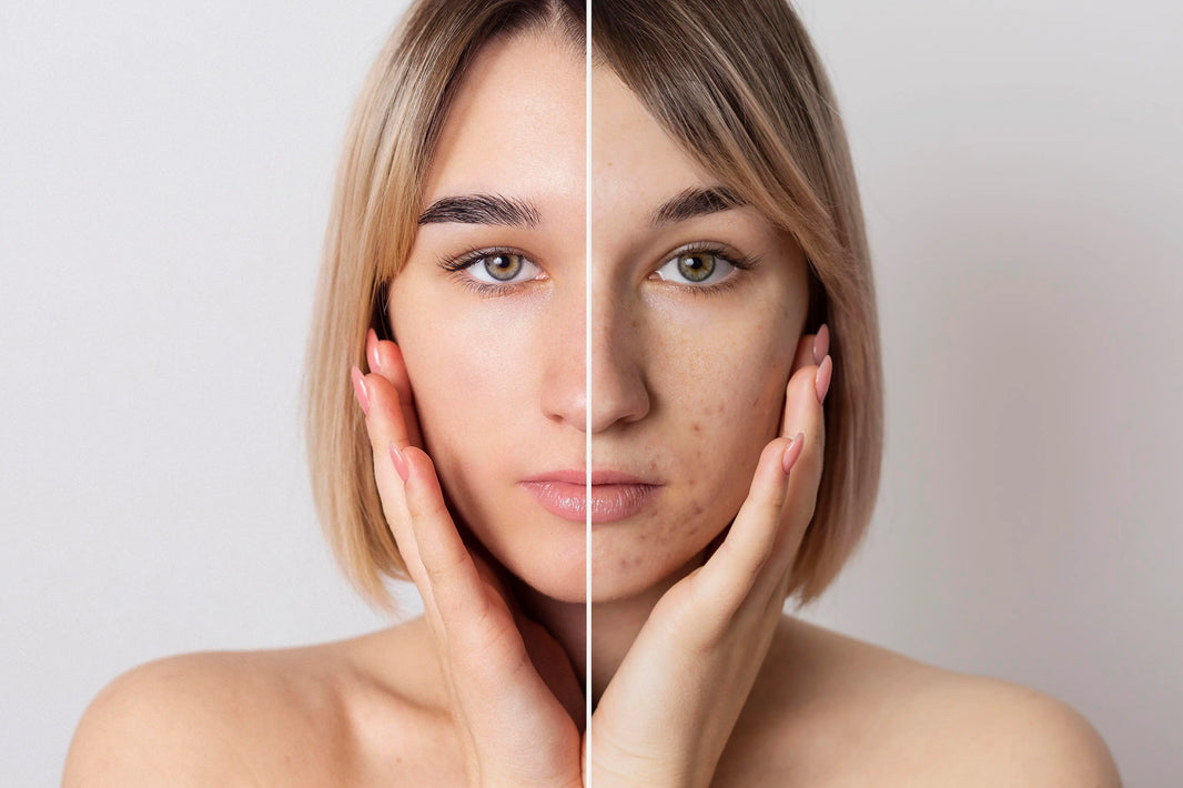 Microneedling vs RF Microneedling