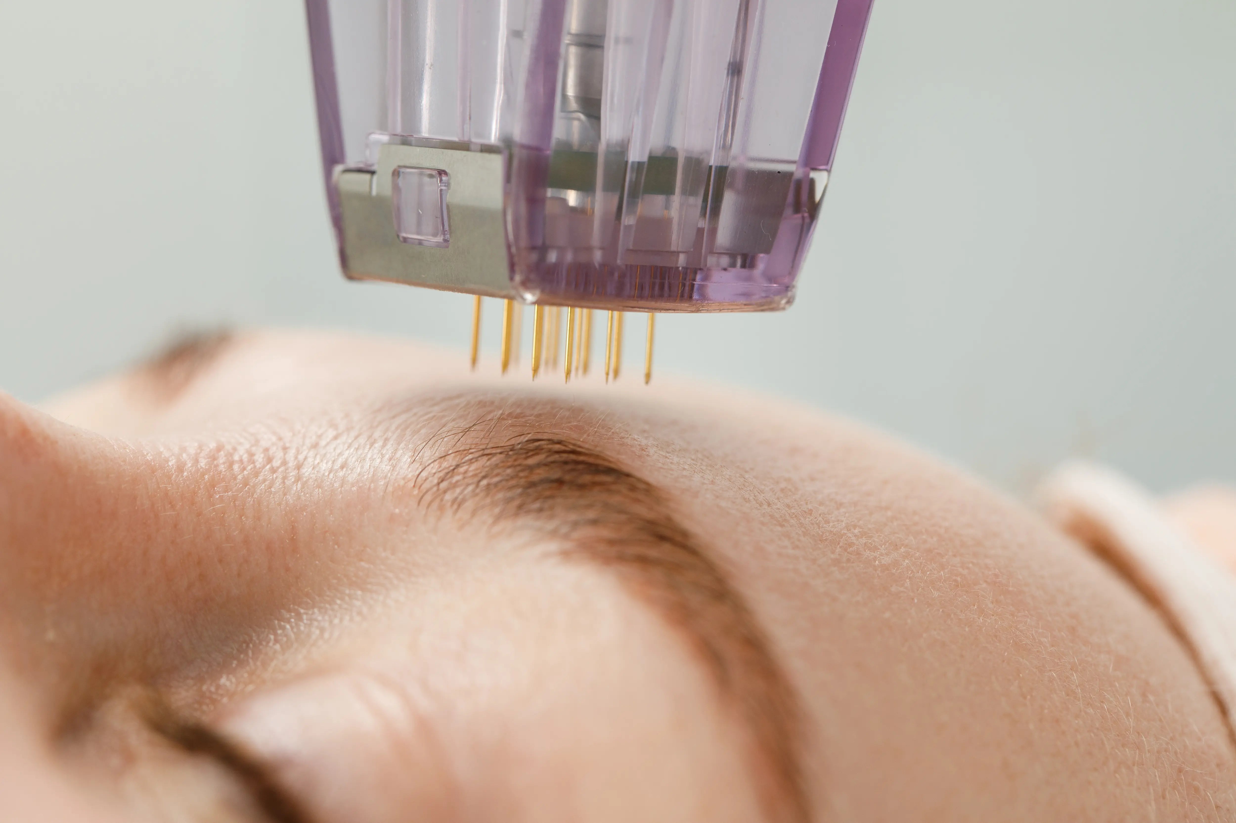 Nano Needling vs Microneedling