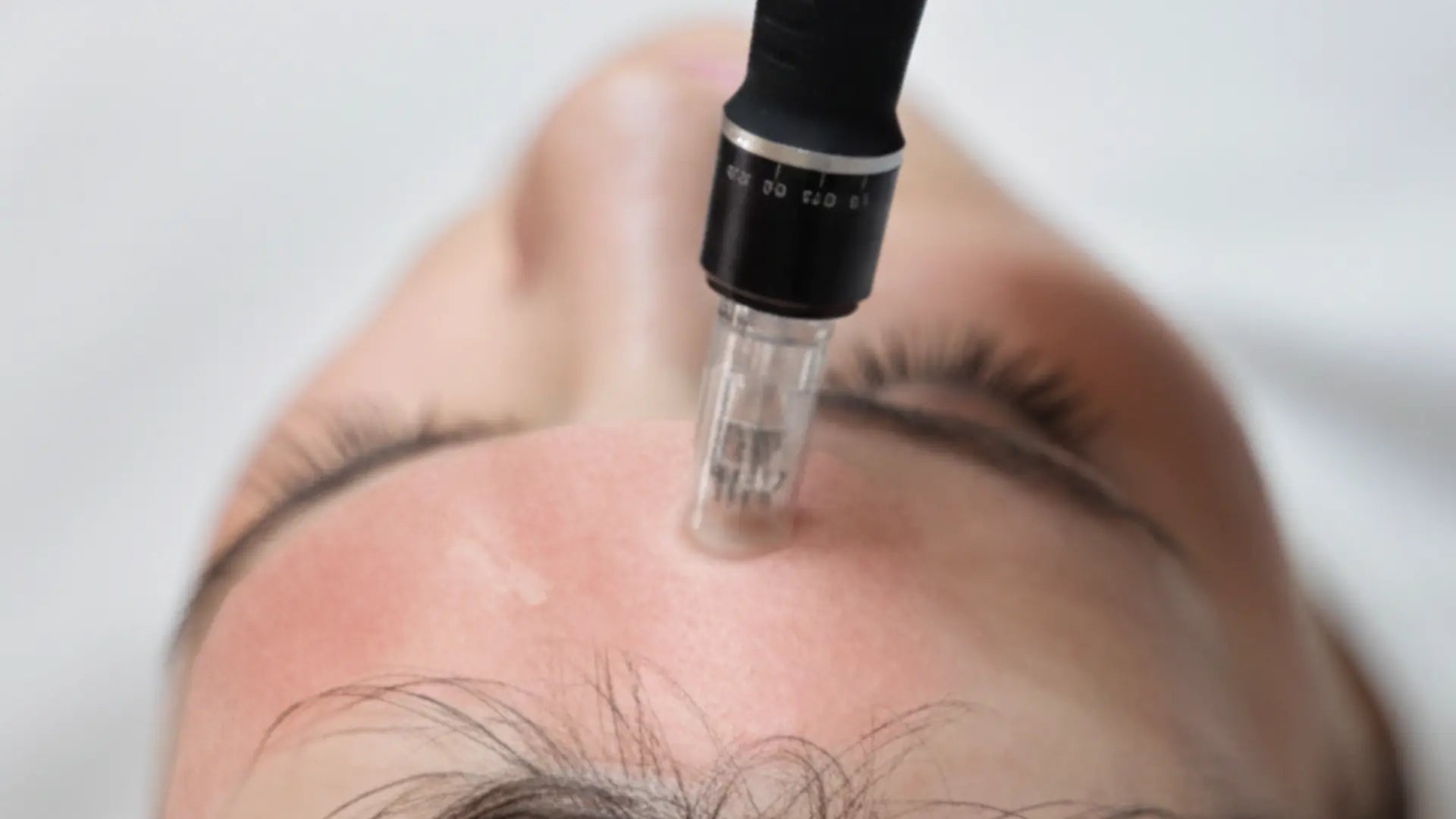 What is RF microneedling treatment?