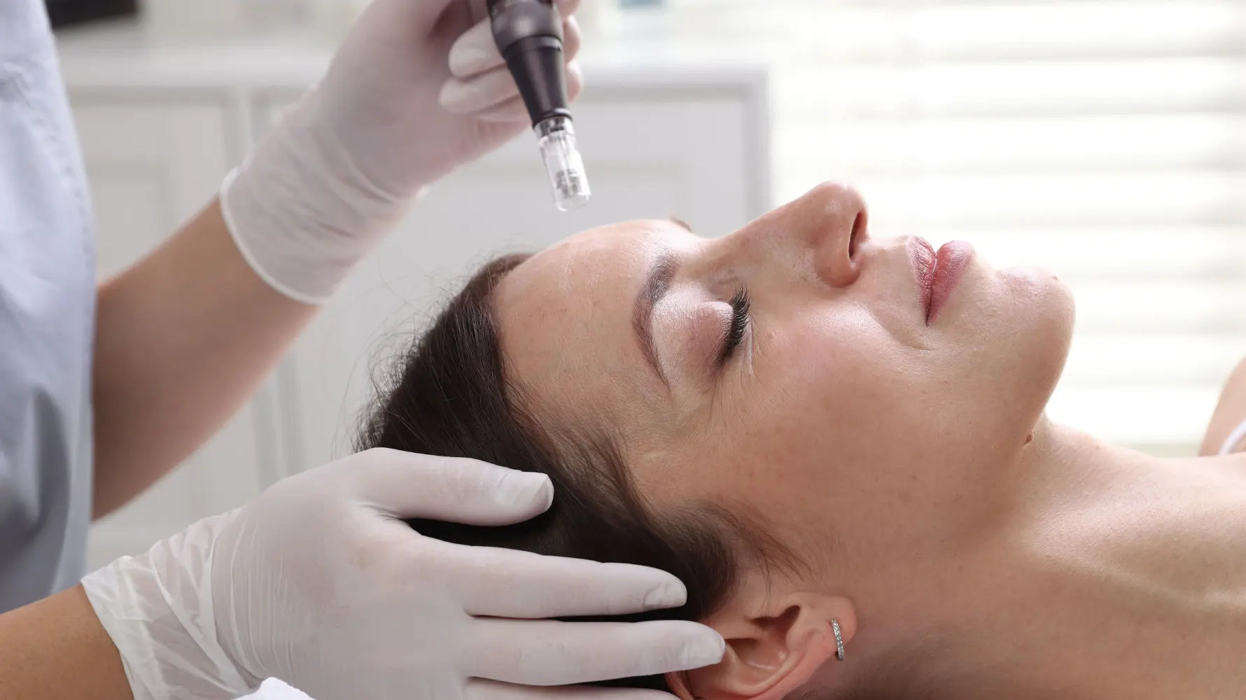 Advantages of Microneedling