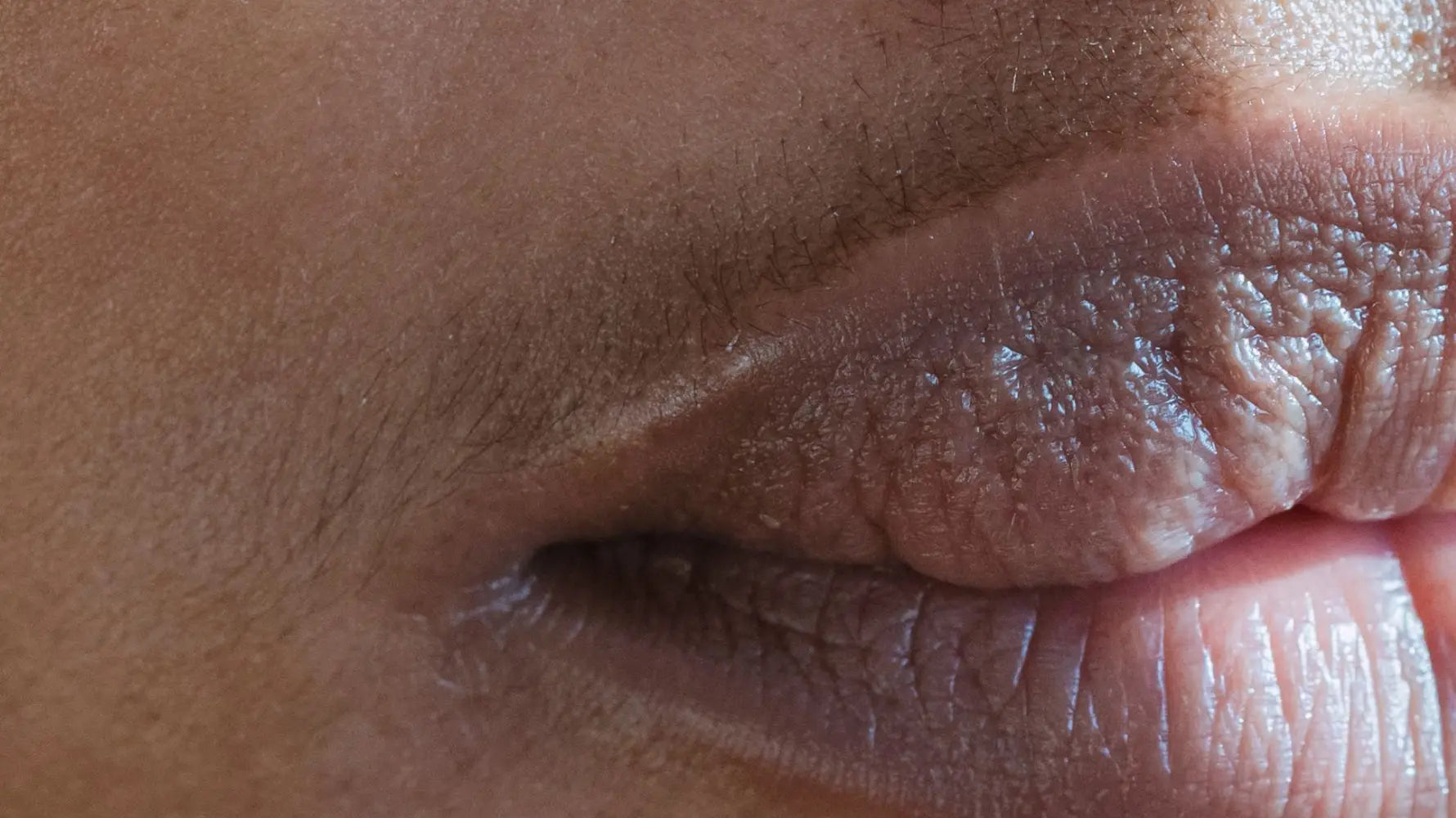 can hyperpigmentation around mouth be cured