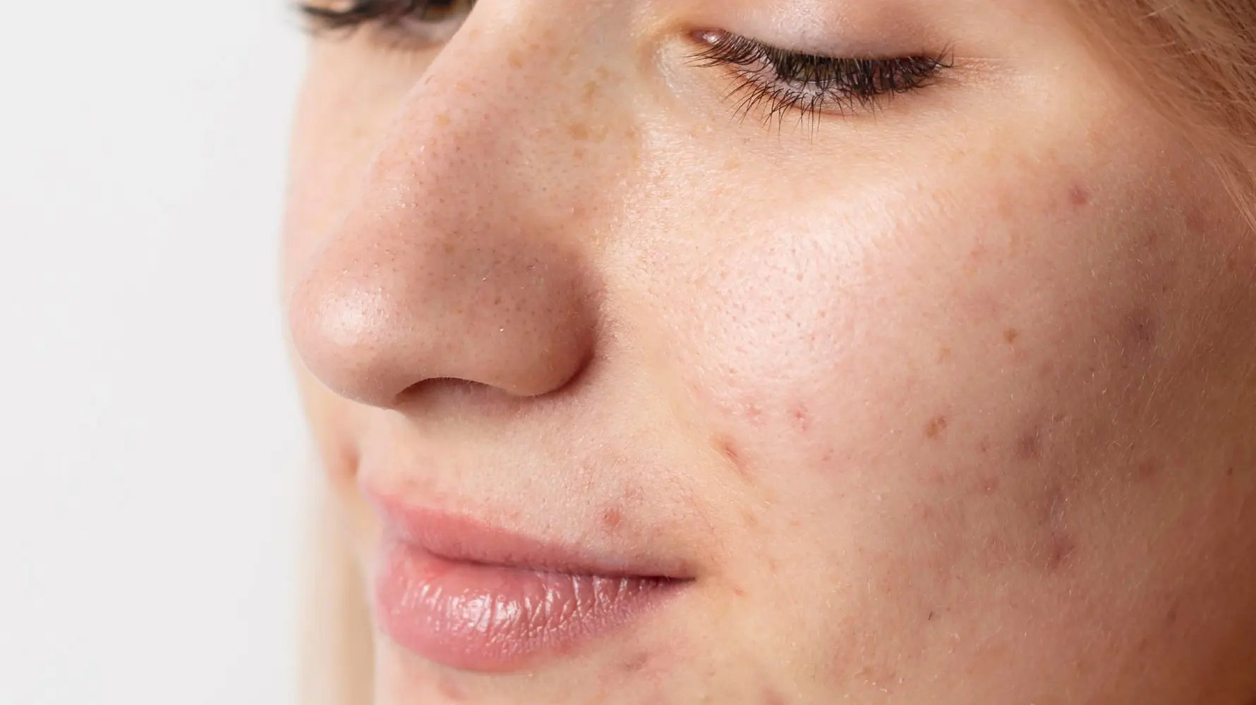can-i-get-microneedling-with-acne
