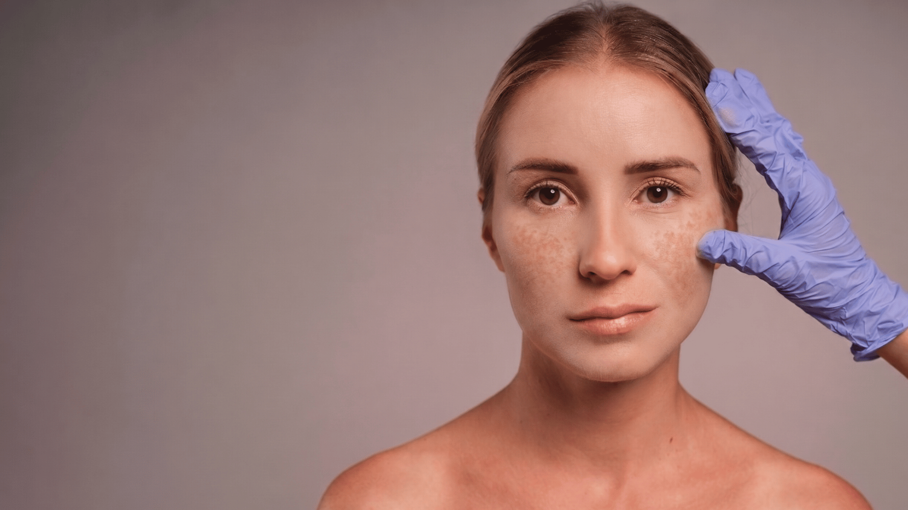 Does Accutane Help With Hyperpigmentation?