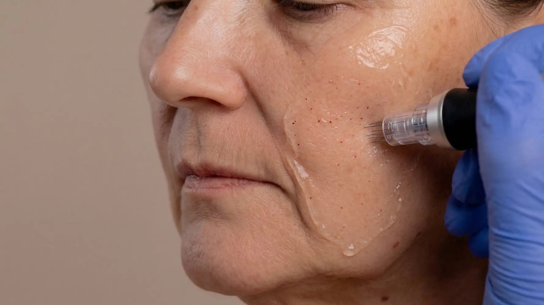 Microneedling For Skin Tightening