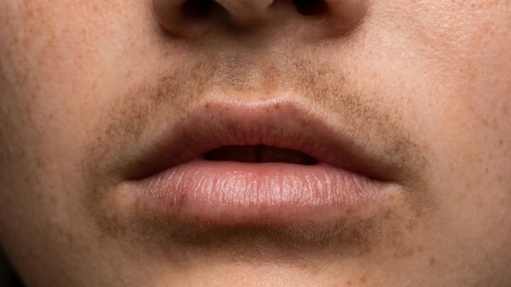 Is It Possible To Get Rid Of Hyperpigmentation Around Mouth?