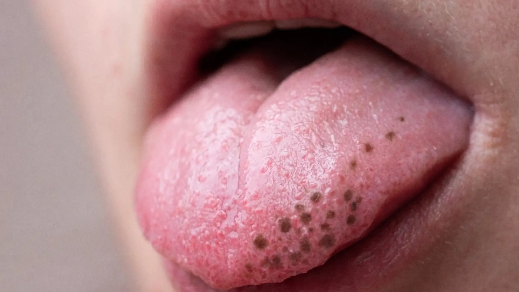 Hyperpigmentation on Tongue