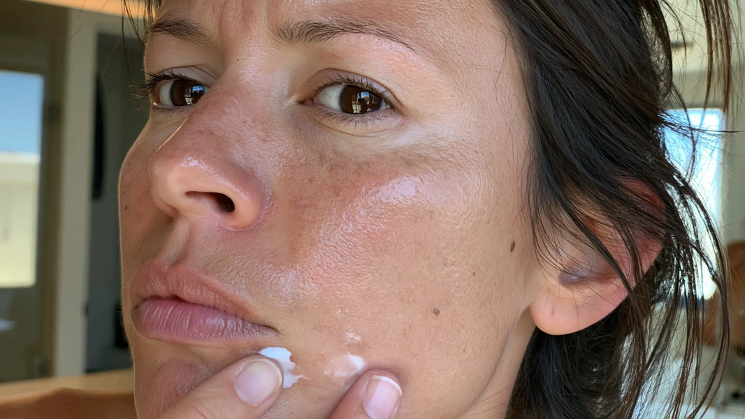 Does Adapalene Help With Hyperpigmentation?