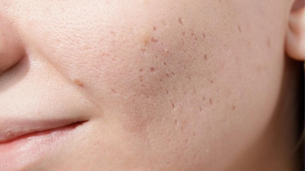 Hyperpigmentation For Acne Scars