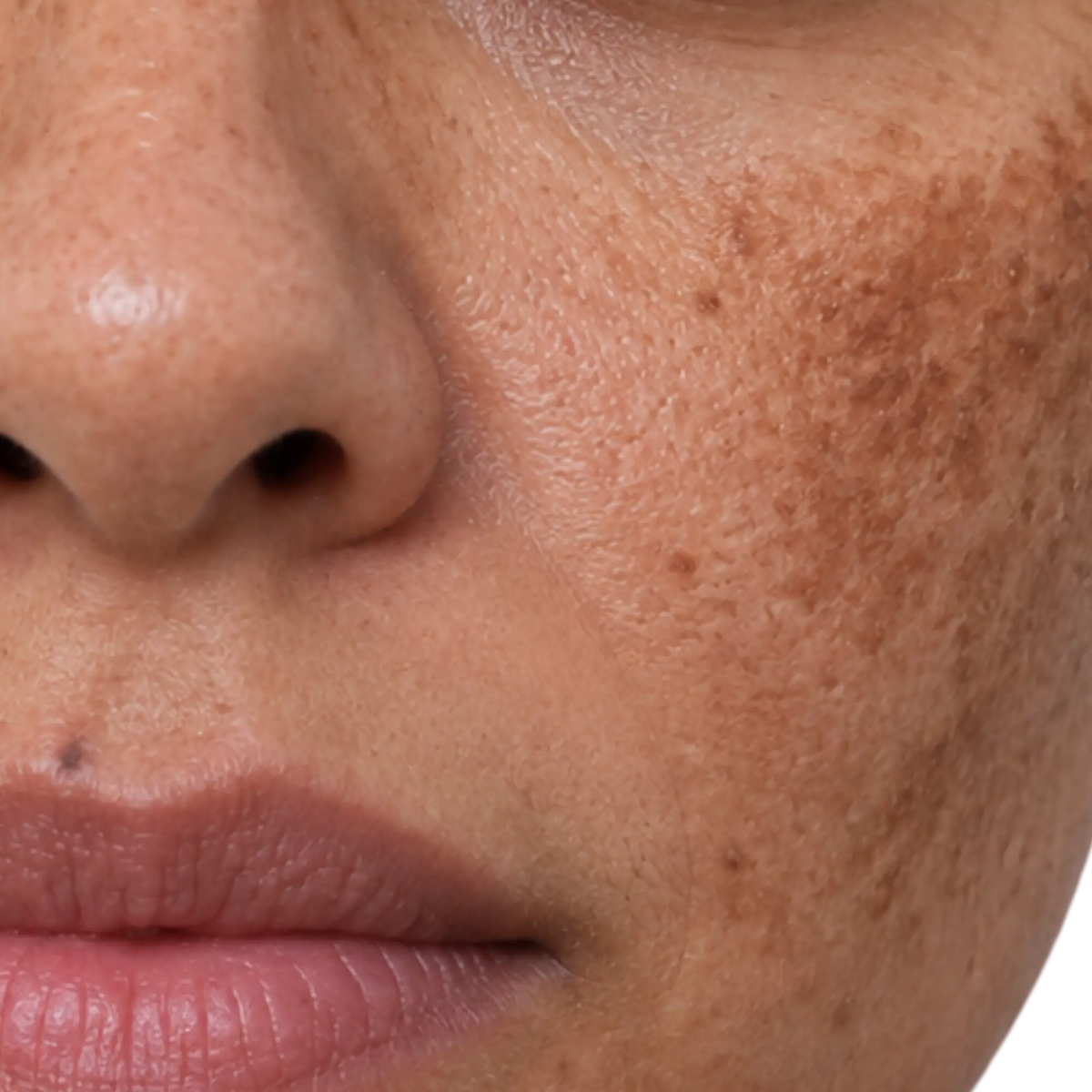 Hyperpigmentation