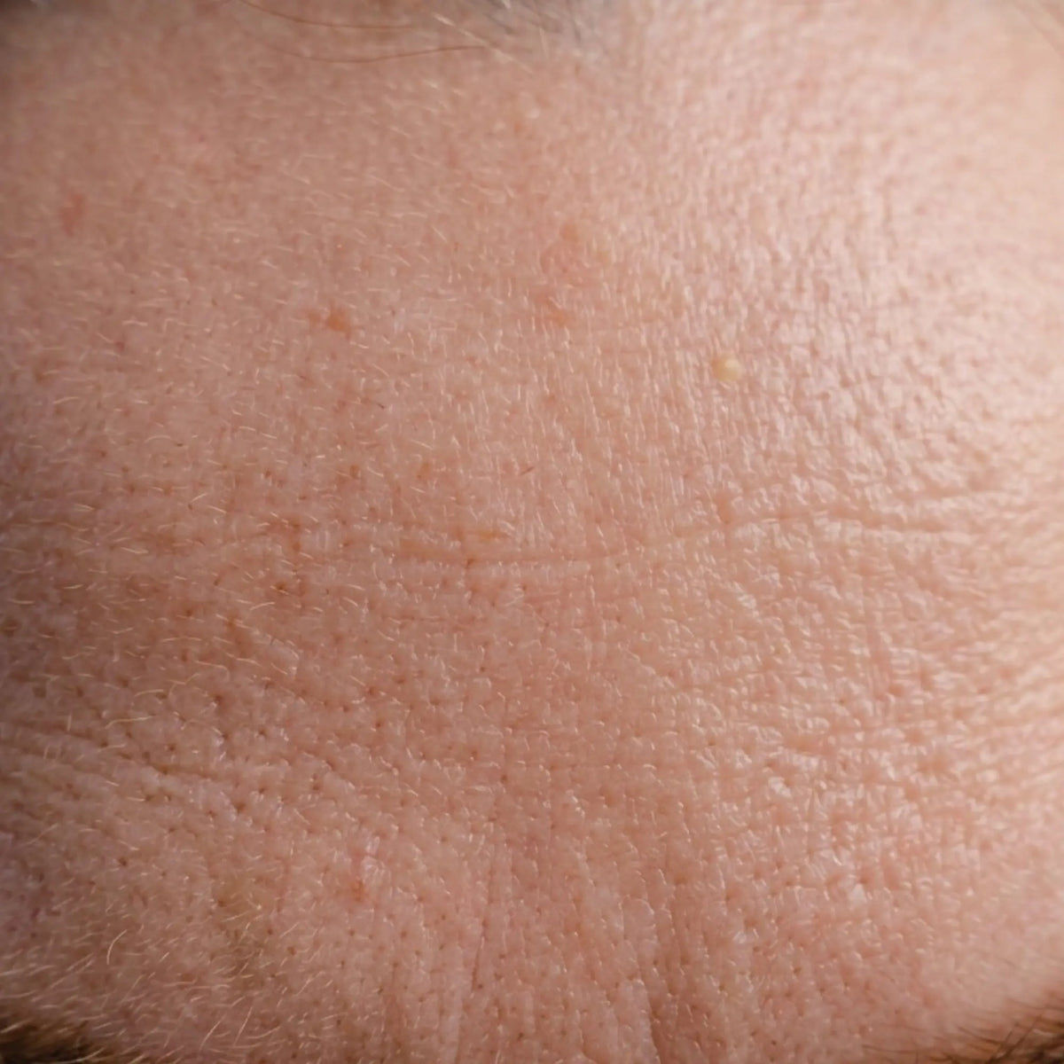 Microneedling before and after