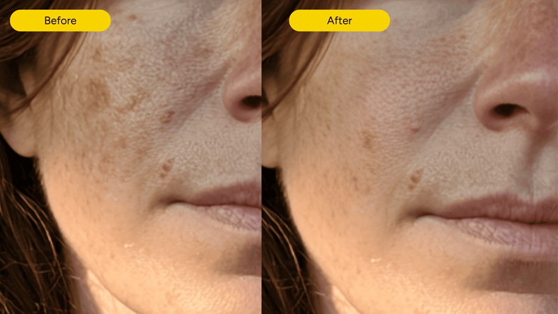 Before and after hyperpigmentation results with exosome serum skincare